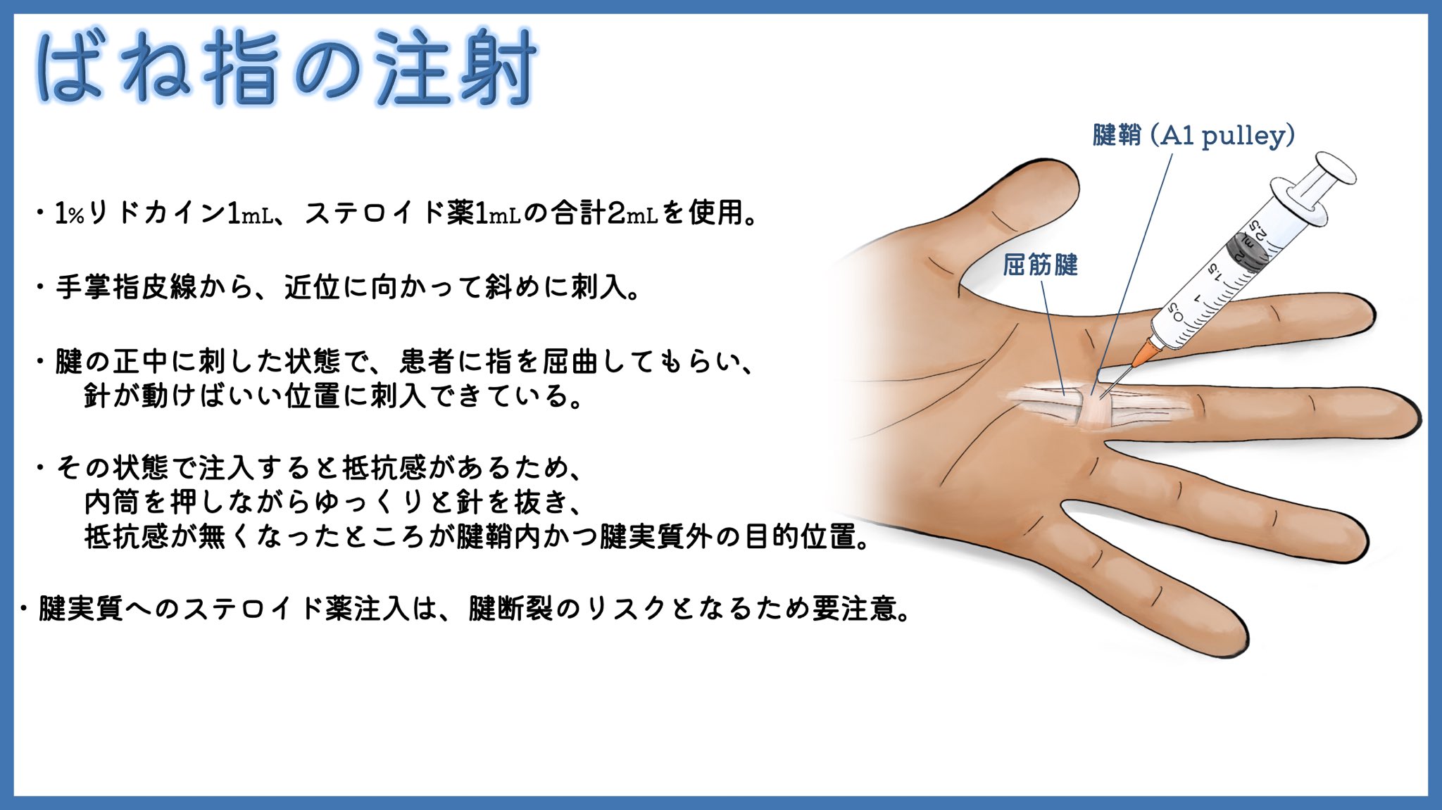 ユジカワ 整形dr イラストレーター ばね指に対しては ステロイド薬の腱鞘内注射が著効することもある 3ヶ月 半年くらい空けて数回打っても症状改善しなければ 手術も選択肢に入ってくる 範囲が狭すぎてエコーしながら打つことは困難なので 手の