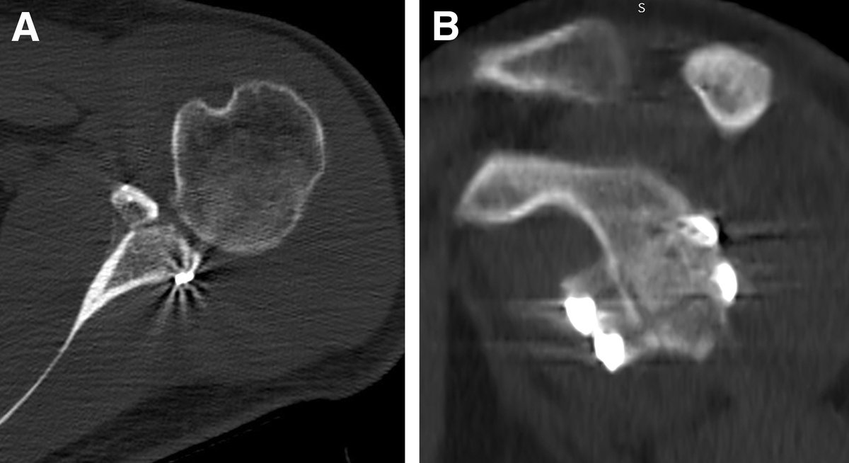 Low recurrence rate following arthroscopic glenoid bone graft combined with subscapularis upper-third tenodesis in patients with both bone loss and hyperlaxity. #shoulder #instability

ow.ly/orOw50EawHs