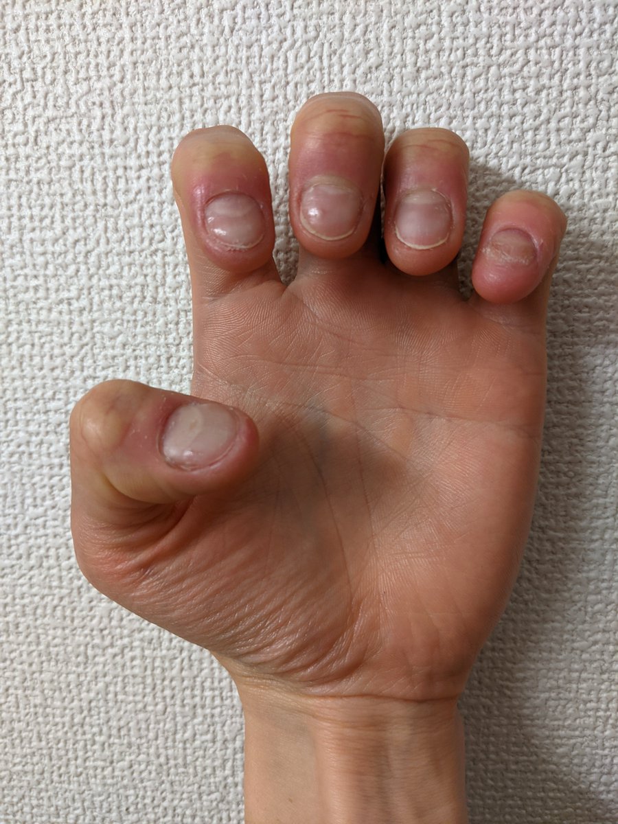 爪噛み男 Nail Biter 6日目 毎日投稿忘れている 爪もダメージを受けている 醜い 基本に戻り ベースコート 保湿 爪噛み克服 深爪矯正 Stopnailbiting 爪噛み男 Nail Biter 6日目 毎日投稿忘れている 爪もダメージを受けている 醜い 基本に戻り ベースコート 保湿 爪噛み克服 深爪矯正 Stopnailbiting