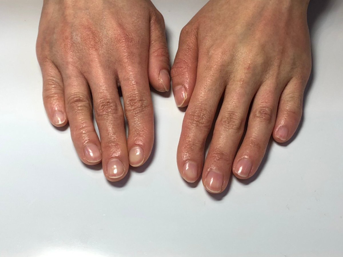 ｴﾘｰｽﾞまい ｵﾀ活できるﾈｲﾙｻﾛﾝ 手荒れでお悩みのトリマーさん Sosoハンドエッセンスの朝晩の塗布 月2回のサロンでのトリートメント 3ヶ月でお肌のキメ トーン 関節のシワなどに変化が見えてきました ハンドケア エイジングケア 手の病院サロン