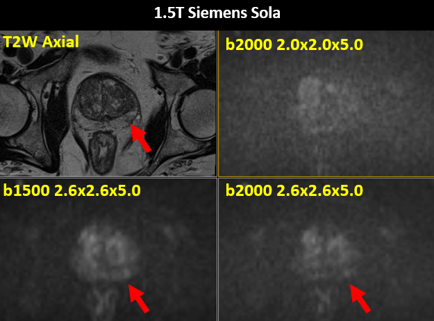 jambor_ivan's tweet photo. @swoo_rad @dr_becker @SiemensHealth 1/3 There is no “preferred” b-value since the same b-value can have very different tissue contrast depending on acquisition parameters #DEVILisINdetails
Oversimplified overview
https://t.co/fUDKhKeP1s
More details in papers such as PMID: 26445008, 26924552, 25046482, … https://t.co/49KH0fxlia