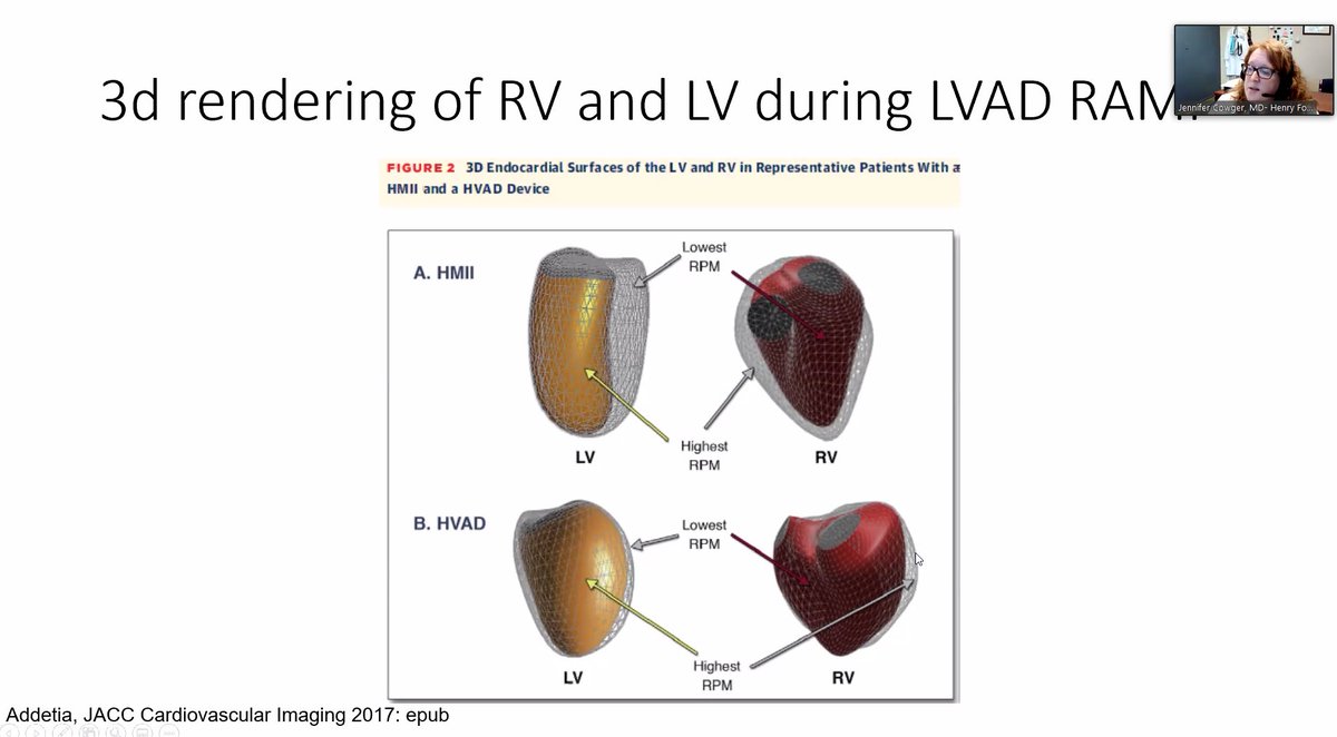 "My concern is that with time the LVAD can lead to the RV to enlarge... especially with some of the newer generation devices." Dr. Cowger  @preventfailure -- HF GRs  @UHhospitals  @CWRUSOM