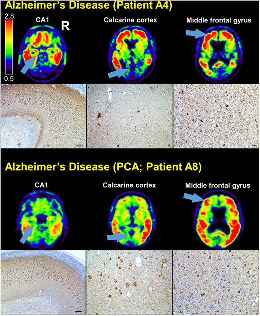 18F-flortaucipir PET to autopsy comparisons in Alzheimer’s disease and other neurodegenerative diseases. bit.ly/39yV3c5 @leoiacca @relajoie @LaurenC_Edwards @UCBerkeleyNeuro @LBNLBioSci @SalvoSpinaSF @ameliastrom @JulieQPham @grinberg_t @tj_mellinger @rana_eser and more!