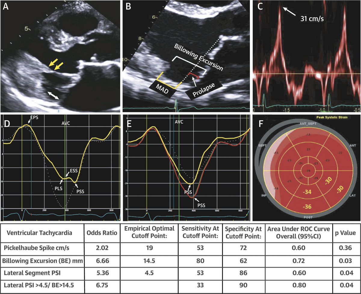 Our findings on Barlow’s MVP patients showing  higher Billowing excursion values in arrhythmogenic  MVP.#Malignant MVP  .@Jamil_tajik <a href="/fuadfehmi/">Fuad Jan</a> @AAH_StLukesCV <a href="/PatrycjaGalazka/">Patrycja Galazka</a> <a href="/BijoyKhandheria/">Bijoy Khandheria</a> <a href="/renujain19/">Renu</a>