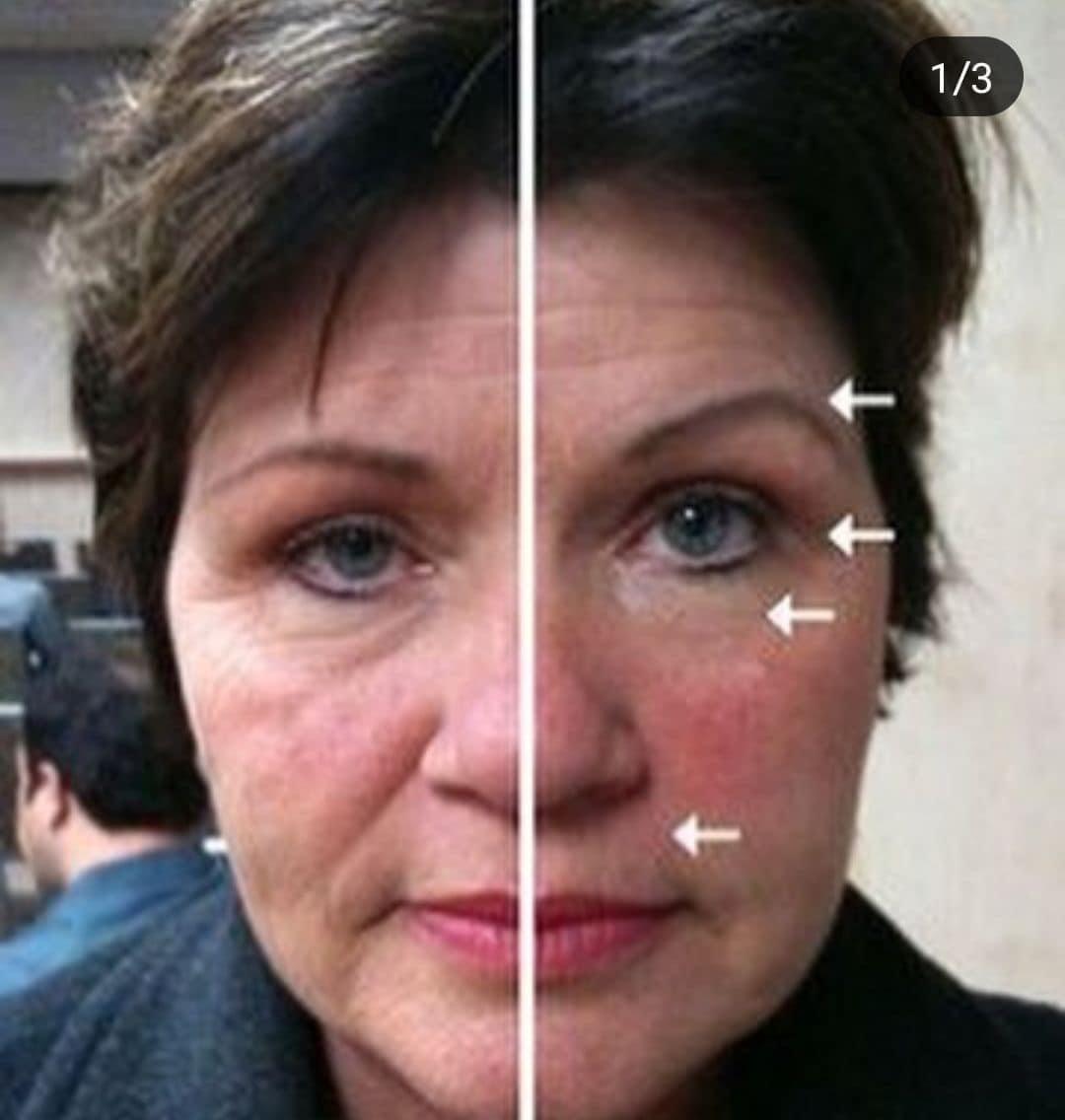 Мезонити для подтяжки груди