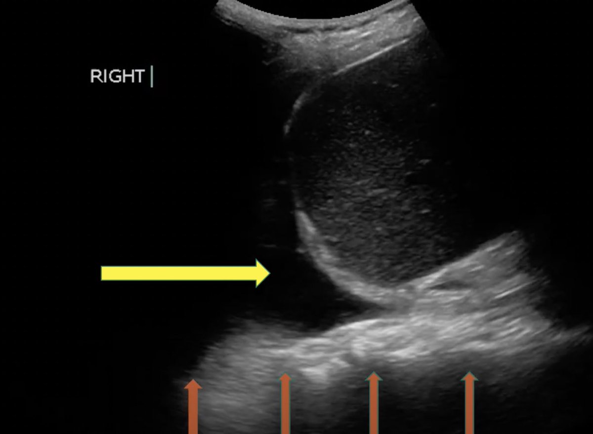 EM Ottawa (@emergmedottawa) on Twitter photo Way Back Wednesday! Unfortunately, COVID cases are on the rise, so we thought we'd refresh ourselves on a lung ultrasound protocol from <a href="/uOttawaPoCUS/">uOttawa PoCUS</a>:
emottawablog.com/2020/06/protoc… Way Back Wednesday! Unfortunately, COVID cases are on the rise, so we thought we'd refresh ourselves on a lung ultrasound protocol from <a href="/uOttawaPoCUS/">uOttawa PoCUS</a>:
emottawablog.com/2020/06/protoc…