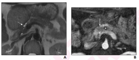 Andrew Rosenkrantz (@arosenkrantzmd) on Twitter photo New <a href="/AJR_Radiology/">AJR</a> Accepted Manuscripts:
"Application of the ACR Pancreatic Cyst Recommendations in Clinical Practice"
🟡Point by Drs <a href="/haileychoi/">hailey choi</a> & Wang <a href="/UCSFimaging/">UCSF Imaging</a>
🟡Counterpoint by Drs <a href="/xrdaveH/">David Hough</a> & Levy <a href="/MayoRadiology/">Mayo Clinic Radiology</a>
ajronline.org/doi/abs/10.221…
ajronline.org/doi/abs/10.221… New <a href="/AJR_Radiology/">AJR</a> Accepted Manuscripts:
"Application of the ACR Pancreatic Cyst Recommendations in Clinical Practice"
🟡Point by Drs <a href="/haileychoi/">hailey choi</a> & Wang <a href="/UCSFimaging/">UCSF Imaging</a>
🟡Counterpoint by Drs <a href="/xrdaveH/">David Hough</a> & Levy <a href="/MayoRadiology/">Mayo Clinic Radiology</a>
ajronline.org/doi/abs/10.221…
ajronline.org/doi/abs/10.221…