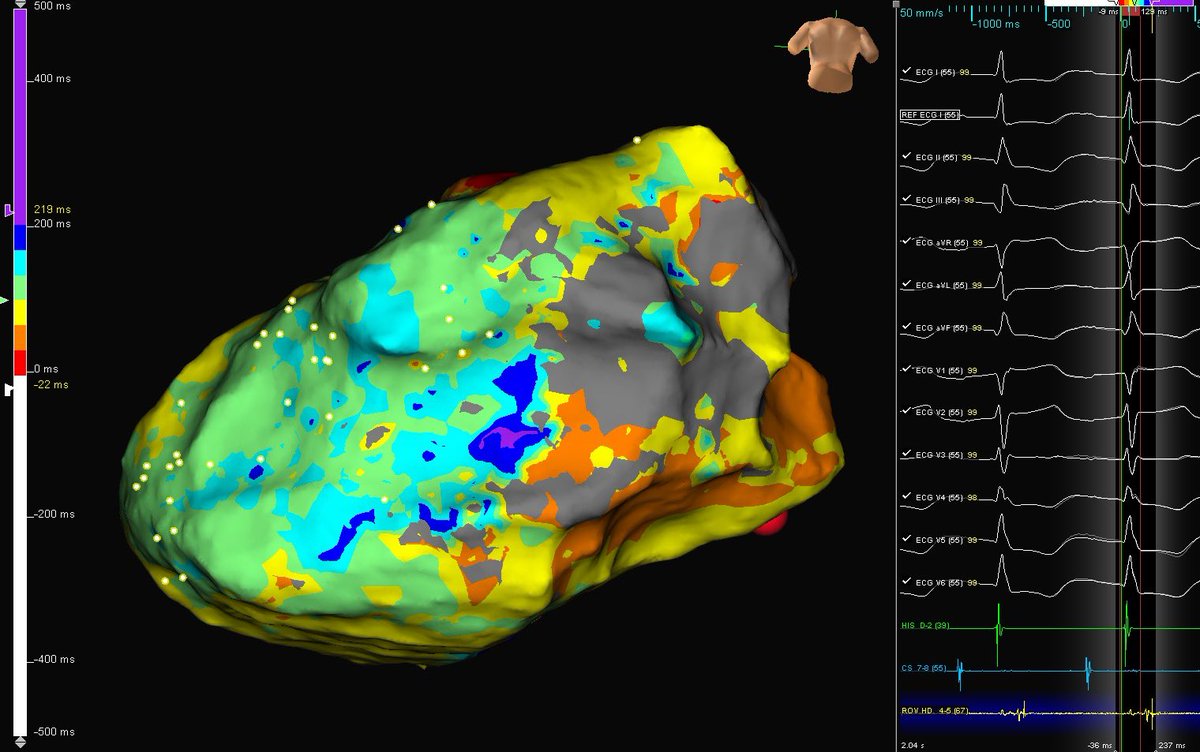 texasEPkait's tweet photo. The #lastdeflection algorithm from @AbbottCardio highlights the DZ and allows for placement of catheter in the interesting area prior to inducing VT, increasing the chance of getting useful data from short runs #epeeps #ablatevt #ilam @PraveenRao_EP https://t.co/ebXfJdmelx