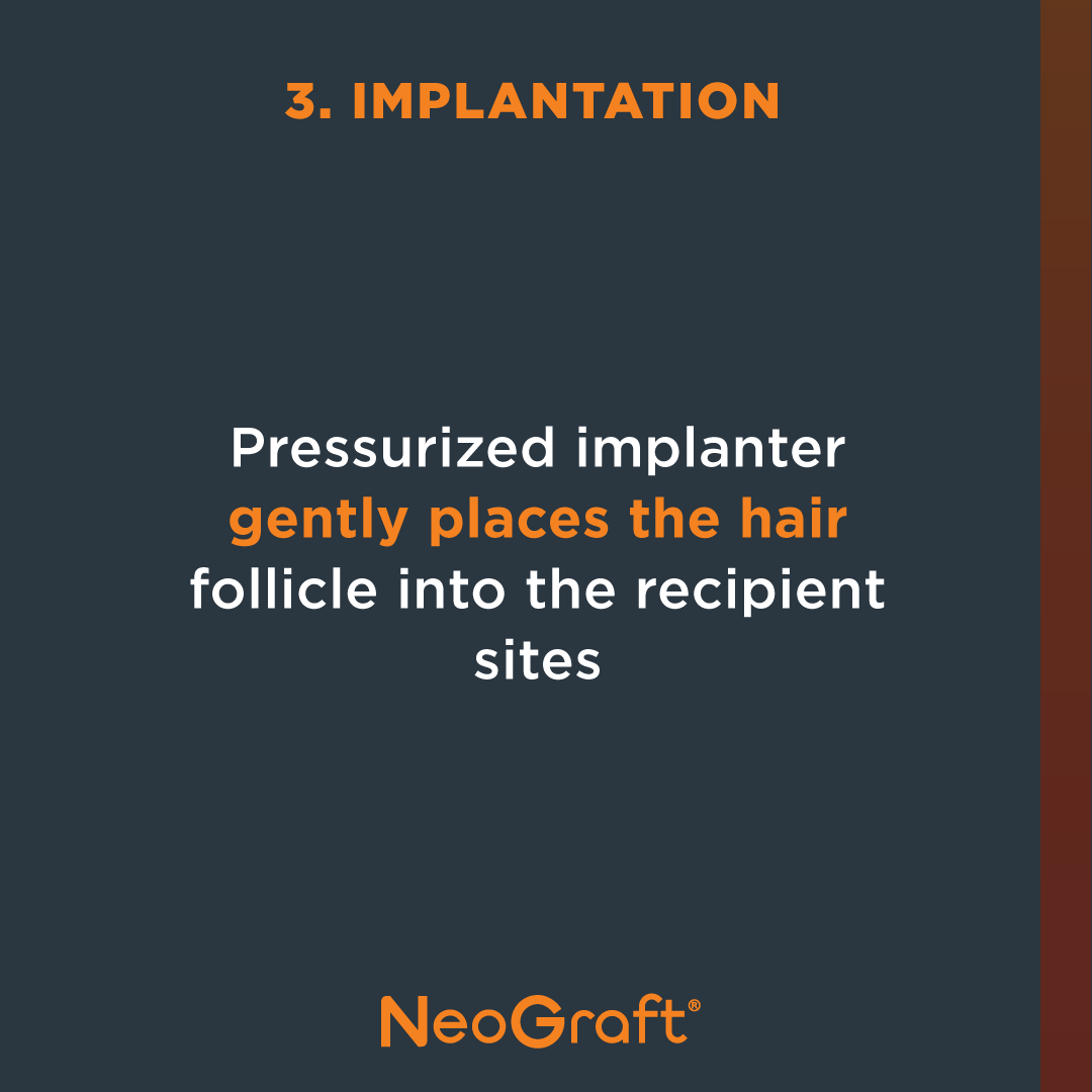 Wondering how a minimally invasive NeoGraft® procedure works? The three steps involved are harvesting, site making, and implantation. Easy as 1,2,3. Schedule a consultation with a certified provider today to see if you are a candidate:  bit.ly/HairProviders