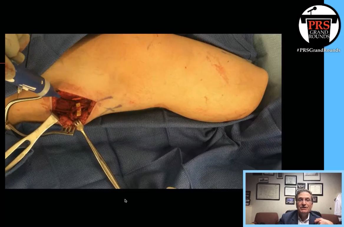 prsjournal's tweet photo. Amazing #PRSGrandRounds on #TargetedMuscleReinnervation!
https://t.co/6l7wXY30sm
Join now and get your questions answered by
@gregdumanian!
#plasticsurgery @NMSurgery @AraSalibianMD
@said_azoury https://t.co/3Xu7WEZ41R