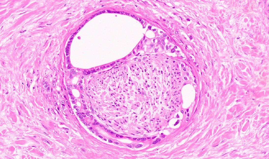 Some Hugs are lethal #pathspotter #liverpath #PathTwitter