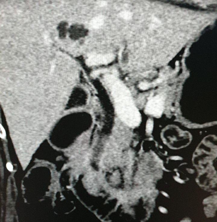 Sharan Wadhwani (@sharanwad) on Twitter photo Happy Easter HPB surgical trainees/residents! Can’t take full credit for today’s case.
60F few months epigastric pain. ALP 243, GGT 67 other LFTs normal. Here are reconstructed CT images. No other imaging.
Diagnosis/plan?
#hpbthursday <a href="/roux_group/">The Roux Group</a> <a href="/siobhanmckay/">Siobhan Mckay</a> <a href="/liveRPancSurg/">Robert Sutcliffe</a> Happy Easter HPB surgical trainees/residents! Can’t take full credit for today’s case.
60F few months epigastric pain. ALP 243, GGT 67 other LFTs normal. Here are reconstructed CT images. No other imaging.
Diagnosis/plan?
#hpbthursday <a href="/roux_group/">The Roux Group</a> <a href="/siobhanmckay/">Siobhan Mckay</a> <a href="/liveRPancSurg/">Robert Sutcliffe</a>