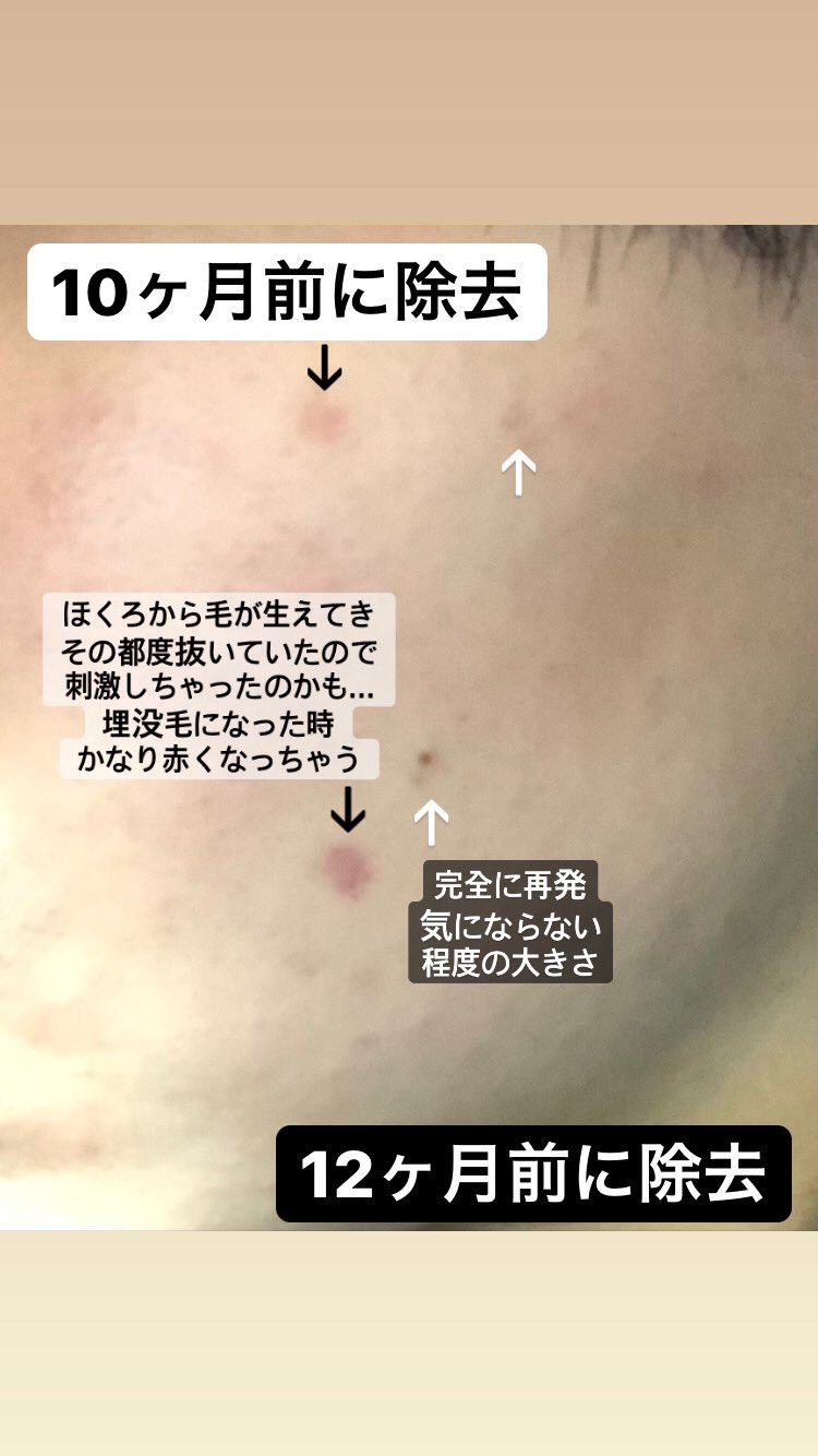 ほくろ除去経過 Twitter Search Twitter
