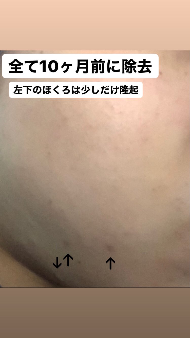 ほくろ除去経過 Twitter Search Twitter