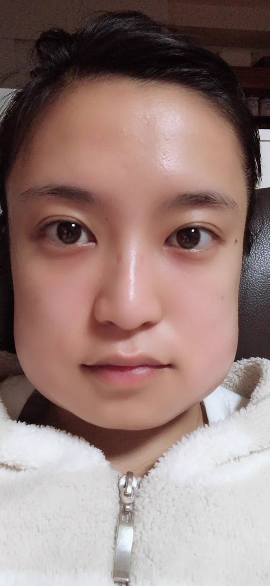 小島瑠璃子さんが親知らずを2本抜歯した結果がこちらｗｗｗ