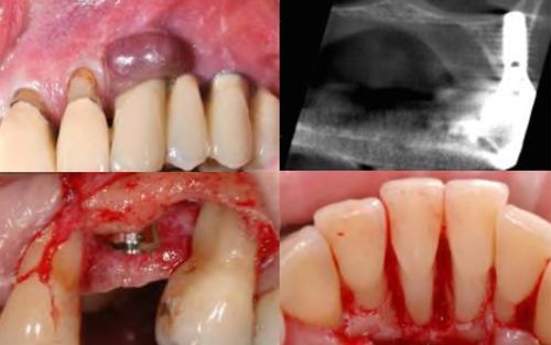"Bewährtes &amp; Neues in der Diagnostik und Therapie für die Praxis" ist das Thema des Kurses mit Prof. Schmidlin und Prof. Bornstein am 3. Mai - als Live-Streaming oder on-demand.
#parodontologie #parodontitis #periimplantitis #symposium #update #zahnarzt
bit.ly/3fRrkPJ