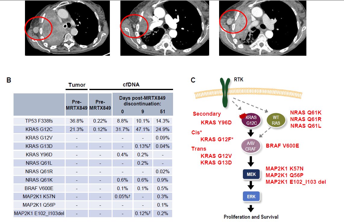 Fascinating paper of mechanisms of #resistance to KRASG12C inhibitors:  1) polyclonal RAS-MAPK reactivation 1 2) KRAS switch-II pocket mutation that impairs binding 
cancerdiscovery.aacrjournals.org/content/early/…