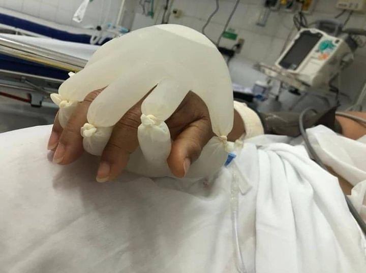 A Brazilian nurses idea to comfort isolated #COVID19 patients in ICU:
2 dispo gloves tied &amp; full of hot water simulating human contact “this hot water glove improves patient's perfusion &amp; I hope the patient feels like someone is holding his hand” (nurse Melo)