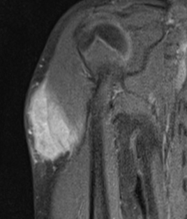 PCYintheCLE's tweet photo. 9 year old presents with a large arm mass and a history of precocious puberty.  T1 / FST2 ax plus FST1+gd cor.   What do you think  #MSKRad #radres #orthotwitter #FOAMrad ? ( will give the answer in a reply to this tweet in a couple of hours ) https://t.co/9cItGzY68P