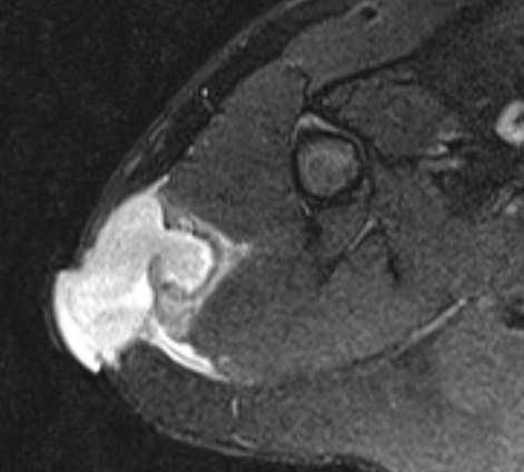 PCYintheCLE's tweet photo. 9 year old presents with a large arm mass and a history of precocious puberty.  T1 / FST2 ax plus FST1+gd cor.   What do you think  #MSKRad #radres #orthotwitter #FOAMrad ? ( will give the answer in a reply to this tweet in a couple of hours ) https://t.co/9cItGzY68P