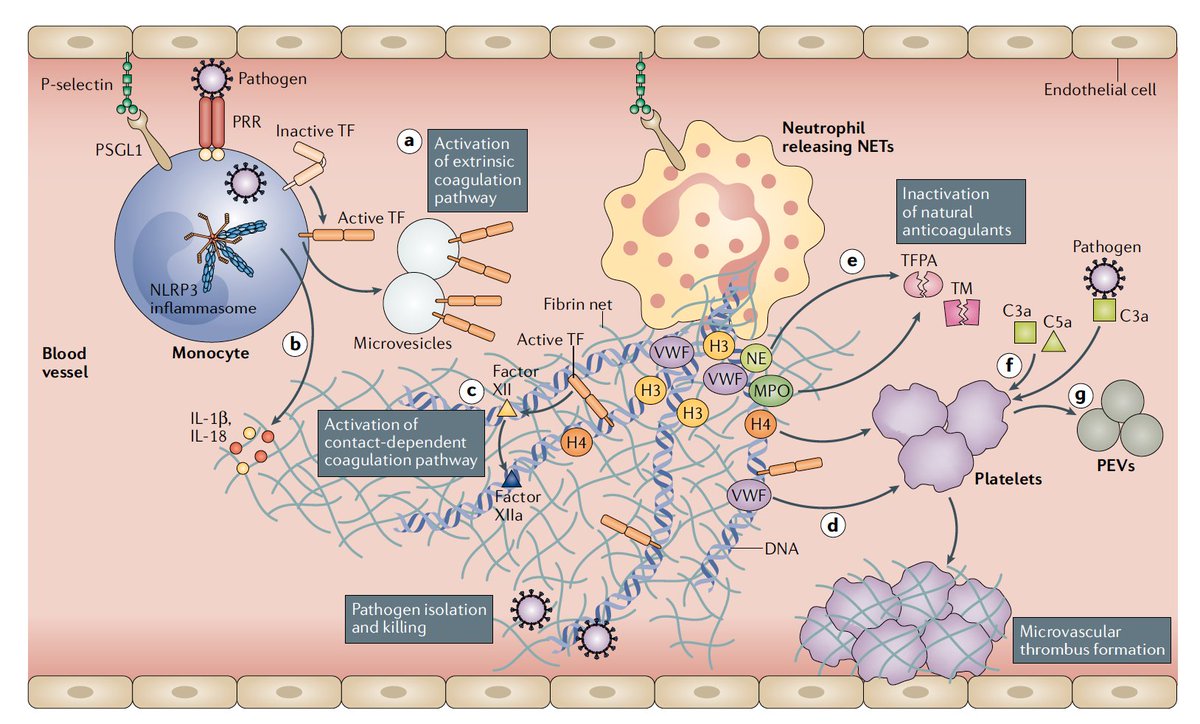 EricTopol's tweet photo. A brilliant review of covid immunothrombosis: how the infection can lead to hyper-inflammation and blood vessel wall dysfunction --> clotting, and how it can be treated https://t.co/xiSbU9zihQ @NatRevImmunol by @aldobonaventura @kmartinod @AbbateAntonio and colleagues @VCU https://t.co/0vZmEywZQw