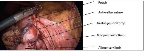 SurgicalTechSTI's tweet photo. Surgical Technique for One-Anastomosis Gastric Bypass
Daniel M Felsenreich, MD, PhD, , MD, Lisa Gensthaler, MD, Natalie Vock, Evi Artemiou, Gerhard Prager, MD, Division of General Surgery, Department of Surgery, Vienna Medical University, Vienna, Austria https://t.co/pFsWPyHQ7U