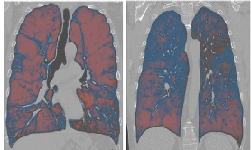 RadiologyCTI's tweet image. ‼️ NEW PUBLICATION ‼️
📜 Automated CT Staging of COPD Severity - Hasenstab et al
🔹CT-based severity stratification of patients with COPD can prognosticate disease progression and mortality
⛓️ doi.org/10.1148/ryct.2…