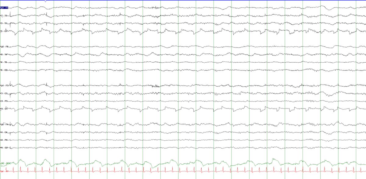 BryanGlezerson's tweet photo. For my EEG colleagues/mentors on the Twitter:

Pt in ICU with COVID-19, intubated, on propofol infusion.

What is the cause of this evolving electrographic pattern?

HFF=70Hz, LFF = 1Hz. Sn = 7uV/mm

@e_gleich @RebeccaFasanoMD @phluaria @TheNotoriousEEG @LadyOcciput @epileptologo https://t.co/rEYdQsrxjP