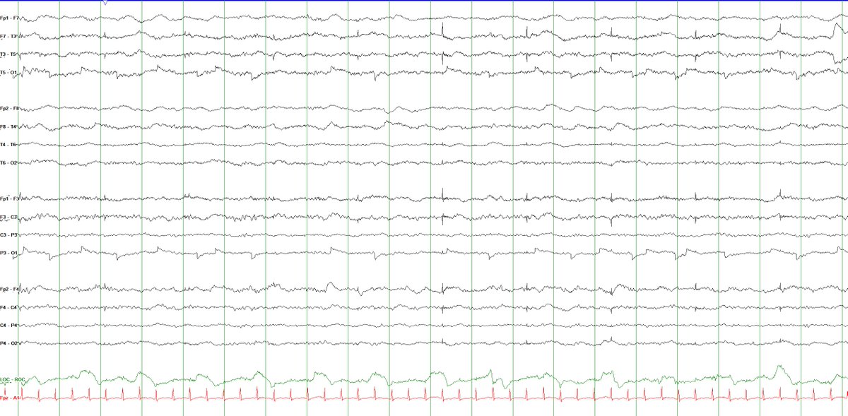 BryanGlezerson's tweet photo. For my EEG colleagues/mentors on the Twitter:

Pt in ICU with COVID-19, intubated, on propofol infusion.

What is the cause of this evolving electrographic pattern?

HFF=70Hz, LFF = 1Hz. Sn = 7uV/mm

@e_gleich @RebeccaFasanoMD @phluaria @TheNotoriousEEG @LadyOcciput @epileptologo https://t.co/rEYdQsrxjP