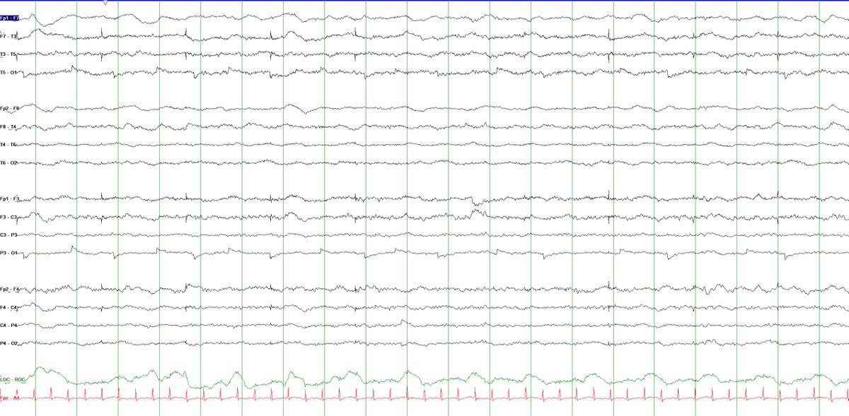 BryanGlezerson's tweet photo. For my EEG colleagues/mentors on the Twitter:

Pt in ICU with COVID-19, intubated, on propofol infusion.

What is the cause of this evolving electrographic pattern?

HFF=70Hz, LFF = 1Hz. Sn = 7uV/mm

@e_gleich @RebeccaFasanoMD @phluaria @TheNotoriousEEG @LadyOcciput @epileptologo https://t.co/rEYdQsrxjP