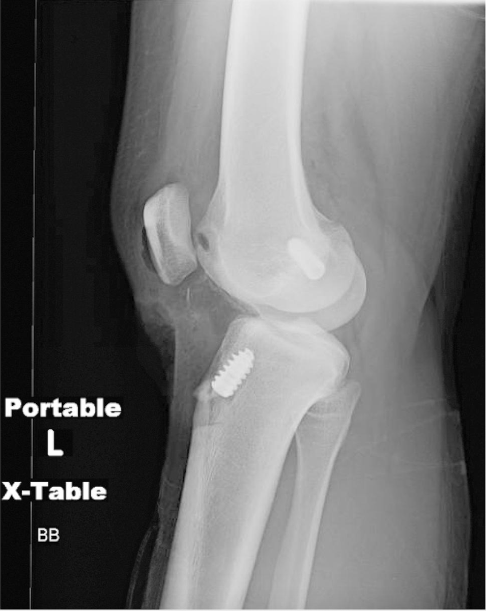 jbjs's tweet photo. Patellar Fracture After ACL Reconstruction: Open Reduction and Internal Fixation with a Maxillofacial Plate

https://t.co/Hi9EjCYLZJ https://t.co/IixNLEnLln
