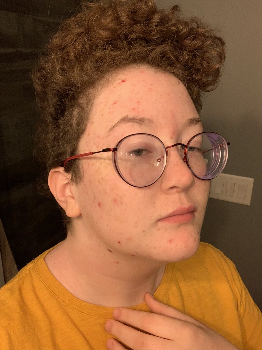 It’s time to be emotionally vulnerable on the internetMy dermatillomana has gotten really bad lately and it’s been making me super self conscious, so I’m posting these pictures that highlight my scabs in an attempt to reverse-psychology myself into being less ashamed