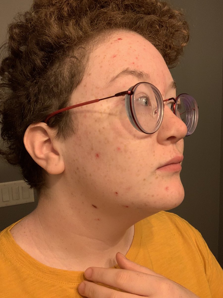 It’s time to be emotionally vulnerable on the internetMy dermatillomana has gotten really bad lately and it’s been making me super self conscious, so I’m posting these pictures that highlight my scabs in an attempt to reverse-psychology myself into being less ashamed