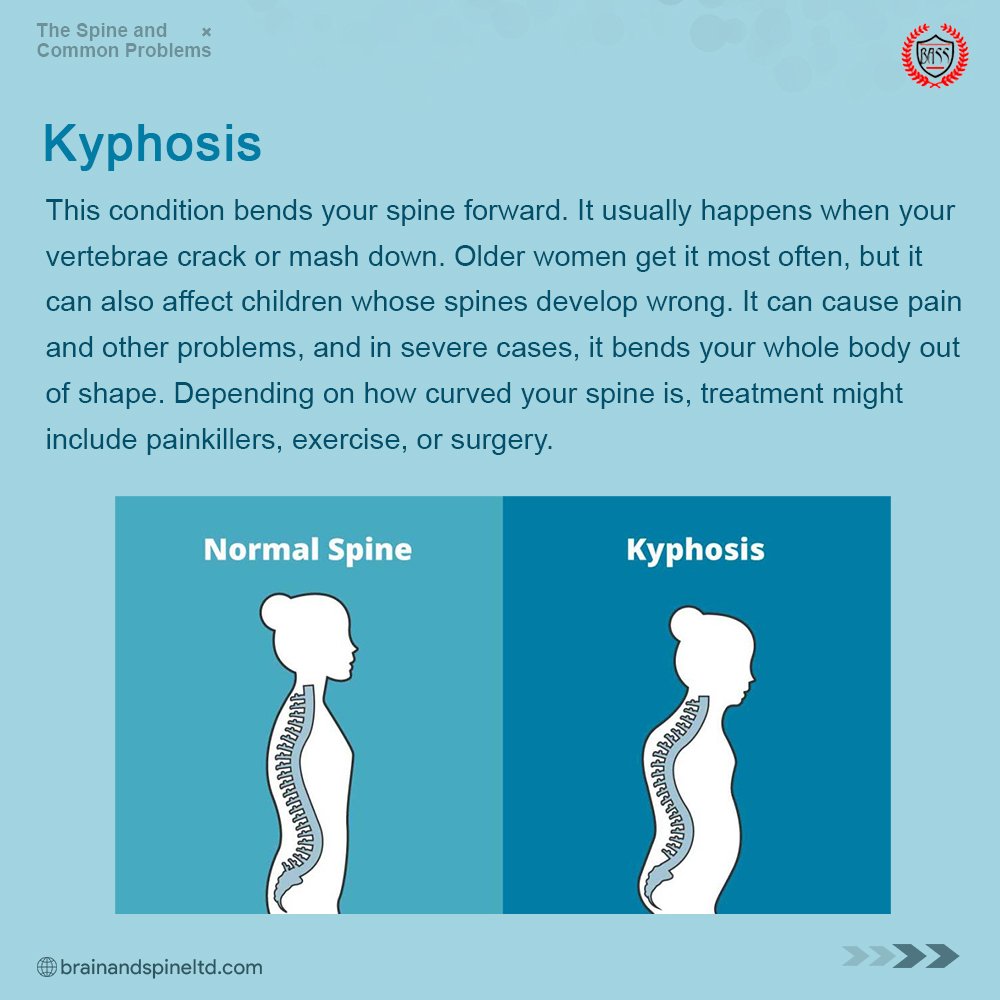 1. KYPHOSIS.This condition is commonly called "HUNCHBACK".Common causes of kyphosis include:- Aging- Muscle weakness in the upper back- Arthritis or bone degeneration- Injury to the spine- Slipped discsKyphosis can lead to pressure on the spine causing pain.