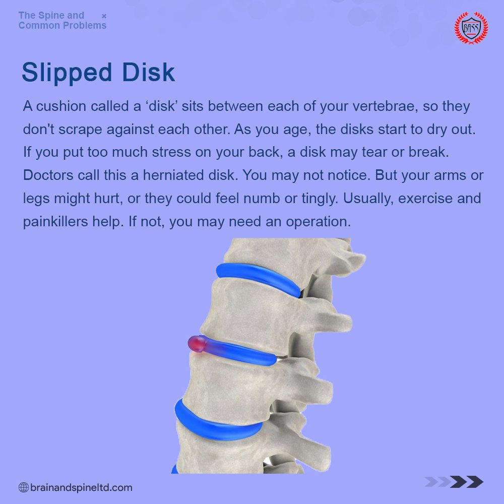 2. SLIPPED DISKThe spine is made up of small bones called vertebrae stacked on each other.In between each bone is a "disk" that protects the bones by absorbing shocks from daily activities. A slipped disk refers to a problem with one of the disks in between the vertebrae.