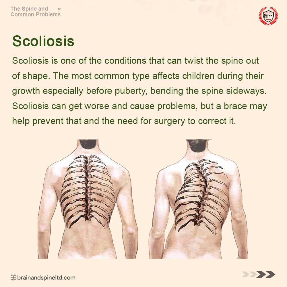 3. SCOLIOSISIt's the abnormal curvature of the spine.The normal shape of the spine includes the curve at the shoulder and the lower back.In scoliosis, the spine is curved in an "S" or "C" shape.Common Causes include :- Cerebral palsy- Birth defect- Muscle weakness