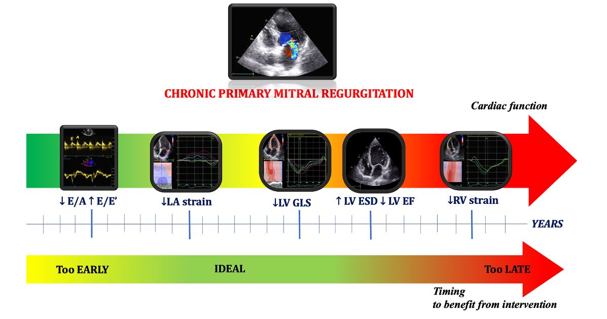 CardioUni Siena (@cardiounisiena) on Twitter photo Choosing the right time for primary MR intervention is still challenging. How can Speckle Tracking help us?
Read our new review!
<a href="/Matte_Cameli/">Matteo Cameli, MD, PhD</a> <a href="/DrGEMandoli/">Giulia Elena Mandoli, MD, PhD, FESC, FISC</a> <a href="/MC_Pastore/">Maria Concetta Pastore</a> <a href="/GBisleri/">Gianluigi Bisleri, MD</a> <a href="/FlavioDascenzi/">Flavio D'Ascenzi</a> <a href="/CavigliLuna/">Luna Cavigli</a> <a href="/marcelohaertel/">Marcelo Haertel Miglioranza</a> <a href="/FocardiMarta/">Marta Focardi</a> <a href="/CiroSantoro17/">Ciro Santoro</a>
pubmed.ncbi.nlm.nih.gov/33829389/ Choosing the right time for primary MR intervention is still challenging. How can Speckle Tracking help us?
Read our new review!
<a href="/Matte_Cameli/">Matteo Cameli, MD, PhD</a> <a href="/DrGEMandoli/">Giulia Elena Mandoli, MD, PhD, FESC, FISC</a> <a href="/MC_Pastore/">Maria Concetta Pastore</a> <a href="/GBisleri/">Gianluigi Bisleri, MD</a> <a href="/FlavioDascenzi/">Flavio D'Ascenzi</a> <a href="/CavigliLuna/">Luna Cavigli</a> <a href="/marcelohaertel/">Marcelo Haertel Miglioranza</a> <a href="/FocardiMarta/">Marta Focardi</a> <a href="/CiroSantoro17/">Ciro Santoro</a>
pubmed.ncbi.nlm.nih.gov/33829389/