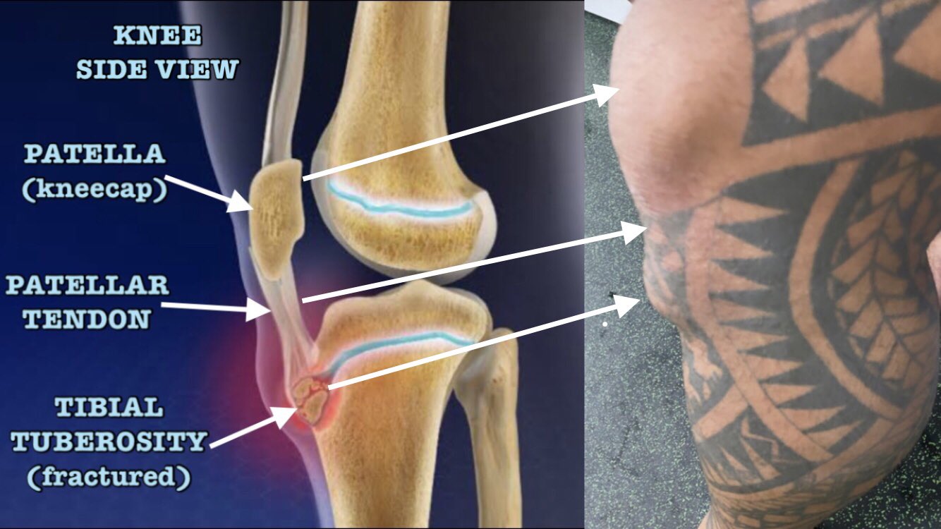 NRL PHYSIO on Twitter: "Complex knee injury for Addin Fonua-Blake. Will  require surgery &amp; 4 months recovery after suffering a tibial tuberosity  fracture, damage to his extensor mechanism &amp; a PCL injury.