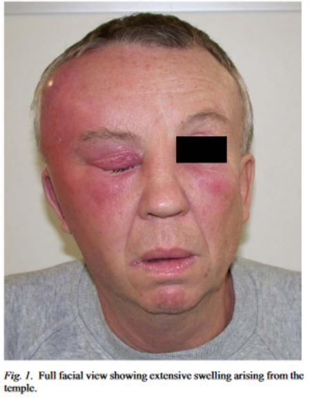 The doctors who examined him noticed 'a small, well-healed laceration at the right oral commissure and pus draining intraorally adjacent to the upper 3rd molar tooth.' There was no other medical history of note. So they drained the infected haematoma on his head. And found...