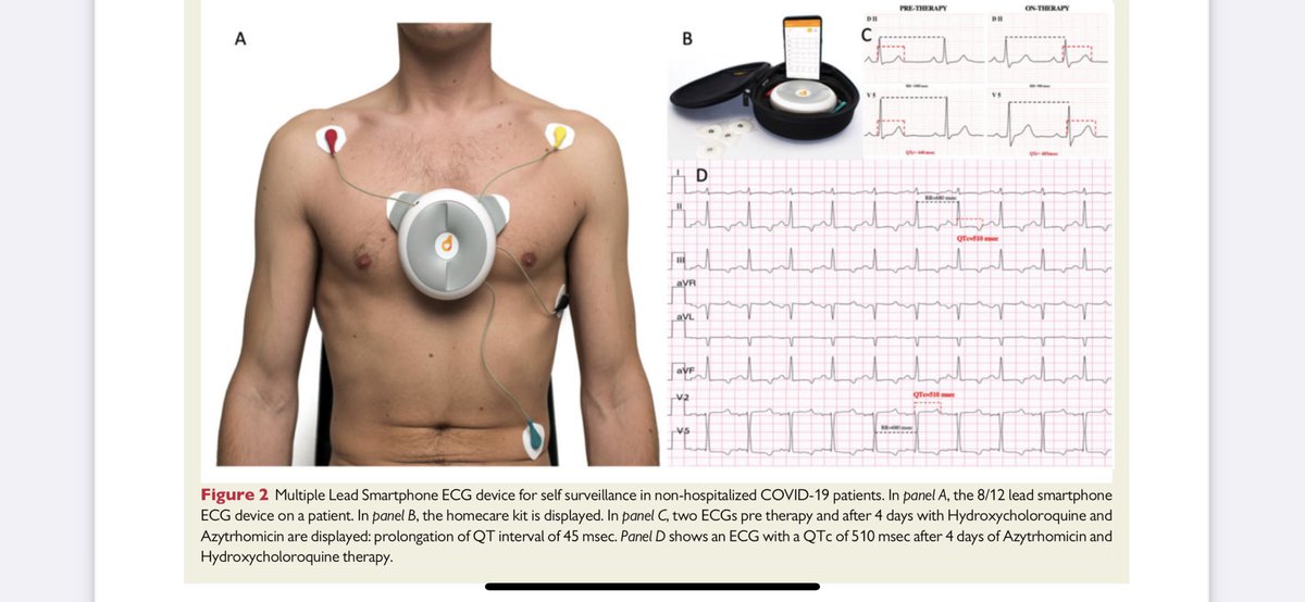 Just published on EHJ digital health: Smartphone ECG surveillance in non hosp COVID-19 patients: prognostic value of baseline ECG alterations + 15% of hospitalisations related to new onset ECG abnormalities. @ESC_Journals @IacopoOlivotto @CarloFumagalli1 #telecardiology #covid