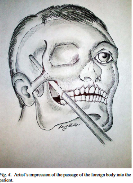 This enormous object had somehow remained embedded in his skull undetected for 11 days. Here is an artist's impression of the route it must have taken.