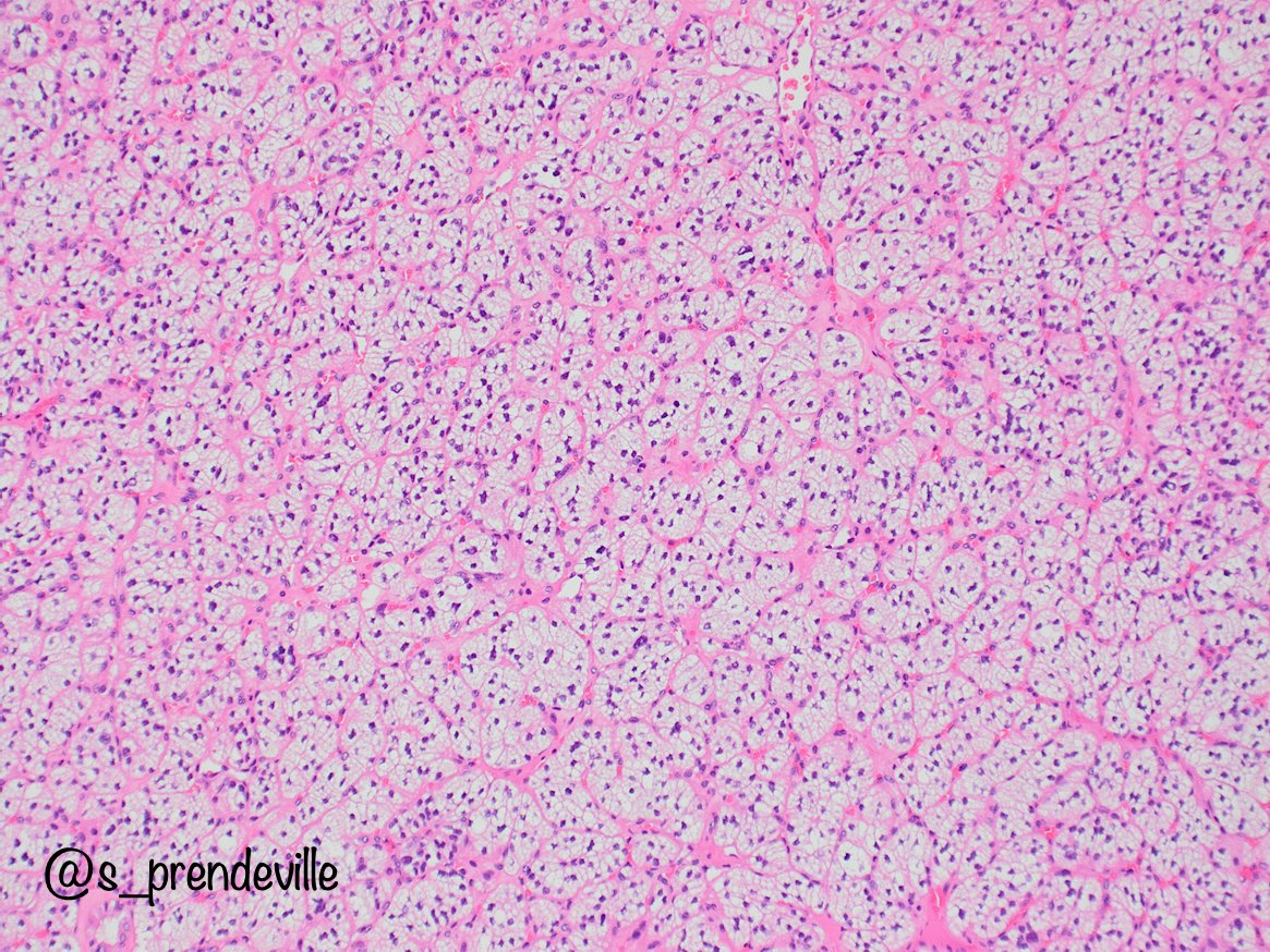s_prendeville's tweet photo. Pancreatic mass ... diagnosis? 🤔

Answer to follow

#pathtwitter #pathresidents https://t.co/66ysvih0CJ