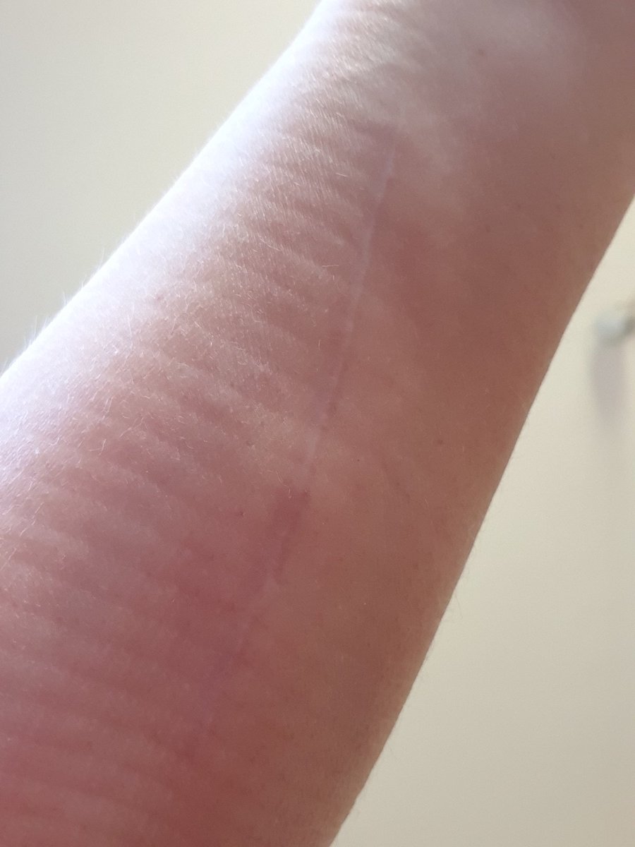 dunkla_rum's tweet photo. Ii som #Inuti
#FotoAbcApril
21.04.09
Idag är det Exakt
10 veckor sedan
som jag fick min
stötvågsbehandling.
Enligt läkarn är det
så lång tid det tar
att läka. Hoppas!!
Domen får jag
nästa vecka. https://t.co/YbAhATSn8g