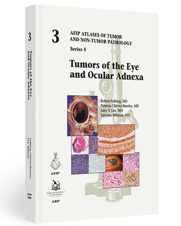 ARP Press (@arp_press) on Twitter photo Starting next week, we’ll feature beautiful images from our Series V, Number 3: Tumors of the Eye and #Ocular Adnexa by <a href="/EyePath/">Robert Folberg</a> @patychevez1 <a href="/StudyPathology/">Amy Lin, MD</a> and <a href="/MilmanTatyana/">Tatyana Milman</a>.
Fascicle available on arppress.org.
#eyetumor #eyepath #pathology #tumor #pathresidents Starting next week, we’ll feature beautiful images from our Series V, Number 3: Tumors of the Eye and #Ocular Adnexa by <a href="/EyePath/">Robert Folberg</a> @patychevez1 <a href="/StudyPathology/">Amy Lin, MD</a> and <a href="/MilmanTatyana/">Tatyana Milman</a>.
Fascicle available on arppress.org.
#eyetumor #eyepath #pathology #tumor #pathresidents