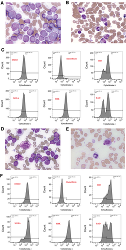 JournalCancer's tweet photo. Acute undifferentiated leukemia (AUL_is a rare hematologic malignancy with a poor prognosis.

Our latest edition of #CancerCaseConundrums indicates that venetoclax was highly active in 2 patients with relapsed AUL and should be studied further. https://t.co/Ddo7WQfIHN https://t.co/HdklqYHbXM