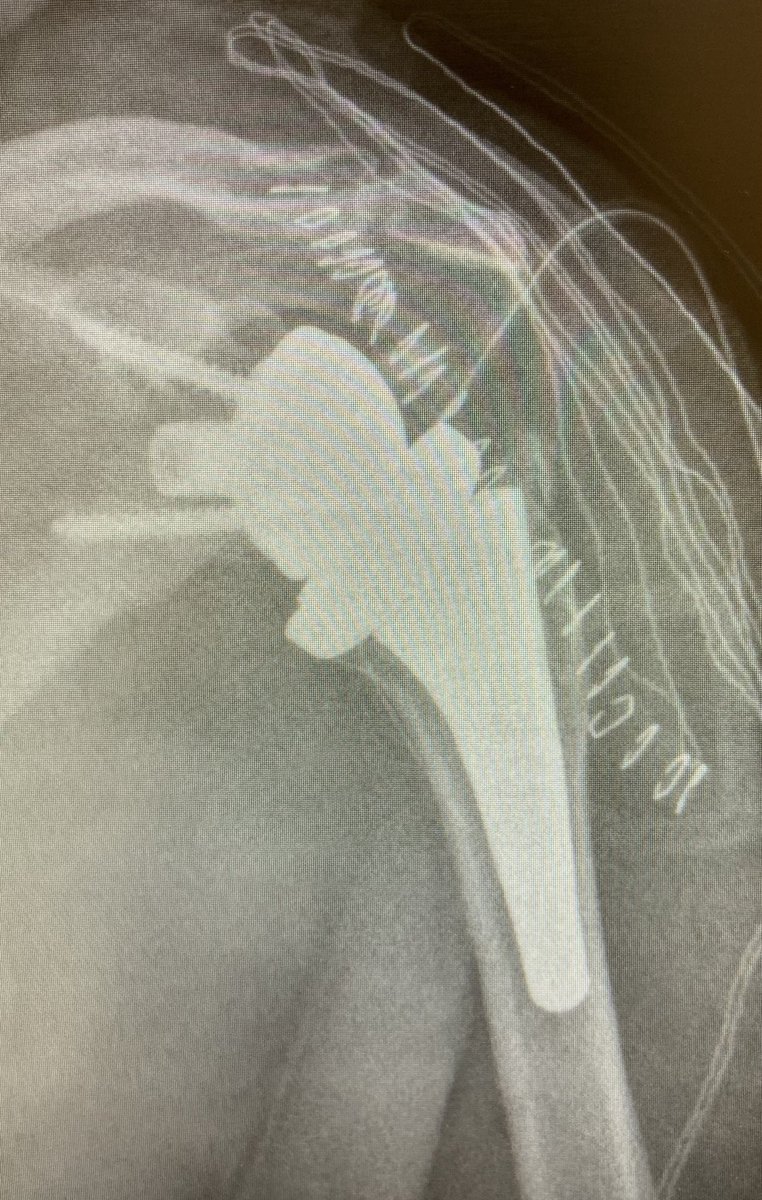 Ayer hicimos nuestra 30ª prótesis de hombro Embrace.
Comenzamos en septiembre de 2020 con esta nueva prótesis de Link. Muy contentos con los primeros resultados.Sistema completo y muy versátil. En este caso, inversa en secuela de fractura luxación en paciente de 76 años. 👍🏼👍🏼