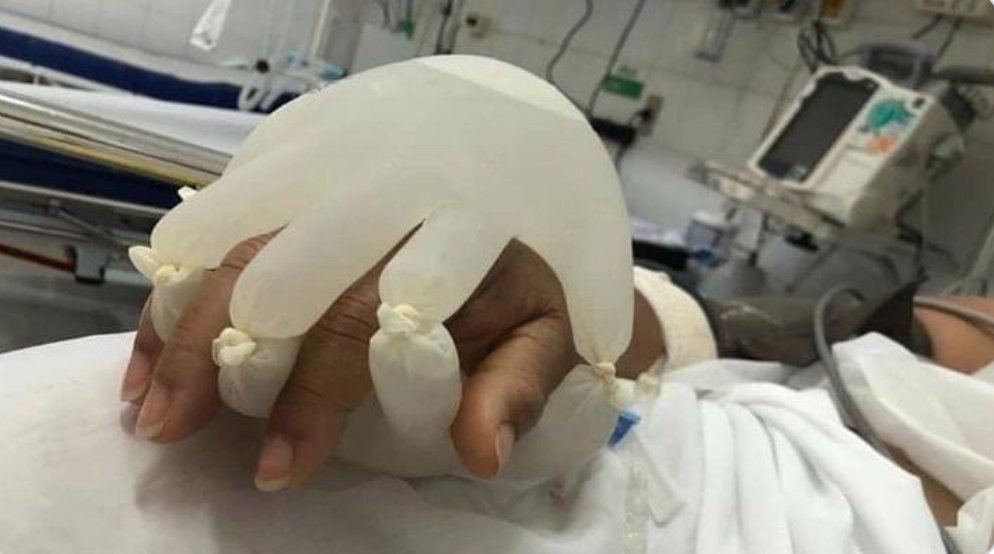 A heartbreaking sign of the times: In isolation wards where patients die alone, craving the touch of their loved ones, nurses fill gloves with warm water to simulate that comfort. They call it the Hand of God.