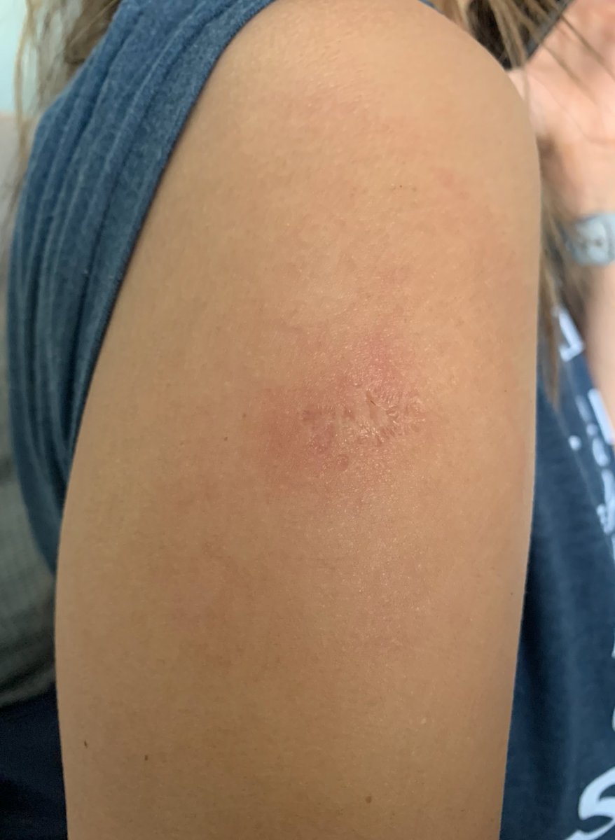 Reaction to COVID-19 vaccine at prior BCG site. My fiancee received the Bacille Calmette-Guérin (BCG) vaccine as an infant in Mexico, which protects against tuberculosis and leaves a scar as shown. 1/4