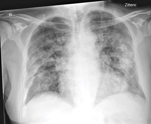 5/ As anyone who’s actually looked after severe COVID will tell you, this isn’t flu. And COVID itself is quite easy to spot on blood tests:- high CRP- a specifically low white cell count (lymphocytes)- low platelets - very high d-dimer X-rays show severe changes in lungs: