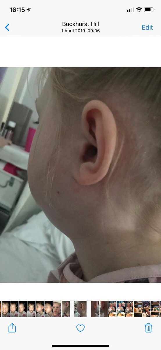 Shingles, virus arthritis , parotitis !  Libby has always had rare and wonderful  diseases/viruses that usually affect adults.  Shingles when she was 3 years old.  Viral arthritis in her leg so she was unable to walk for 2 weeks so couldn’t go to school.   Parotitis ❤️🙏🏼